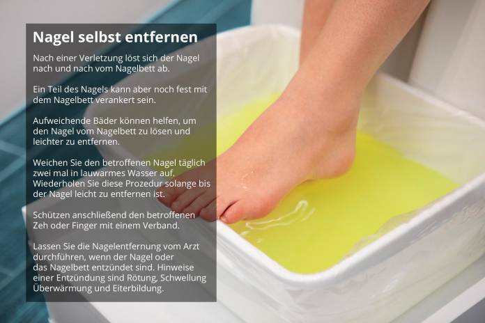 Nagel selbst entfernen