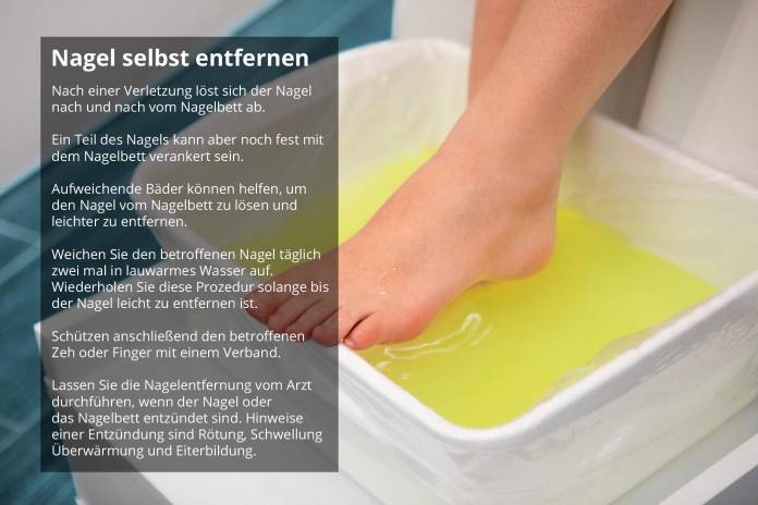 Nagel selbst entfernen