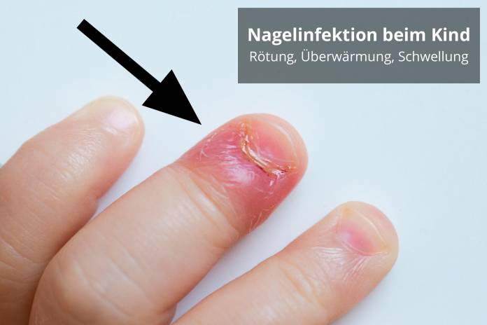 Nagelbettentzündung beim Kind