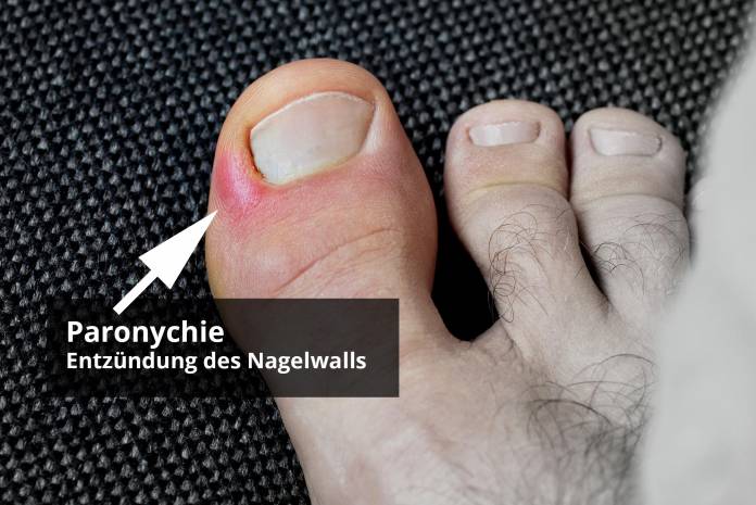 Nagelbettentzündung (Paronychie)