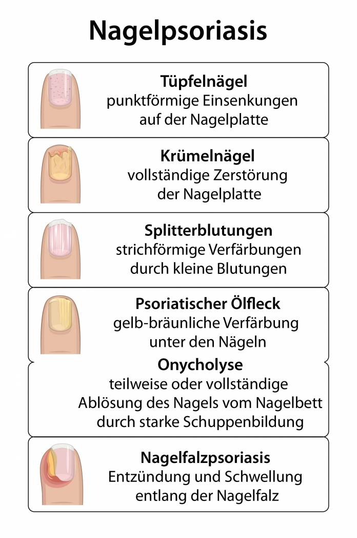 Typische Nagelveränderungen bei Nagelpsoriasis