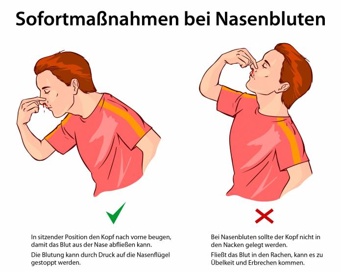 Sofortmaßnahmen bei Nasenbluten