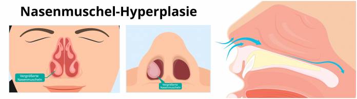 Nasenmuschel-Hyperplasie