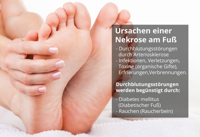 Nekrose am Fuß - Ursachen