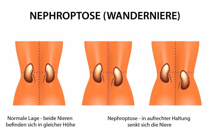 Nephroptose (Wanderniere)