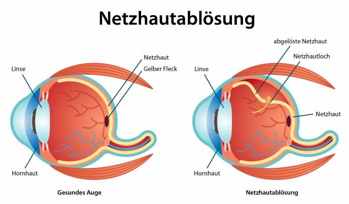 Netzhautablösung