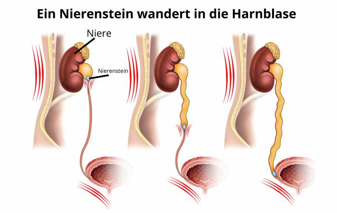 Nierenstein wandert zur Harnblase