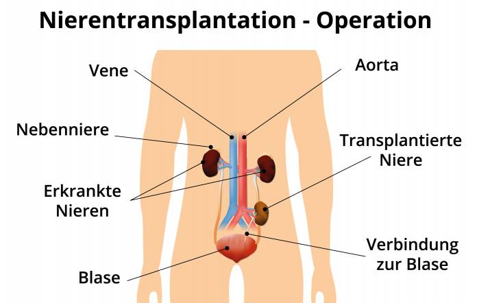 Nierentransplantation - Operation