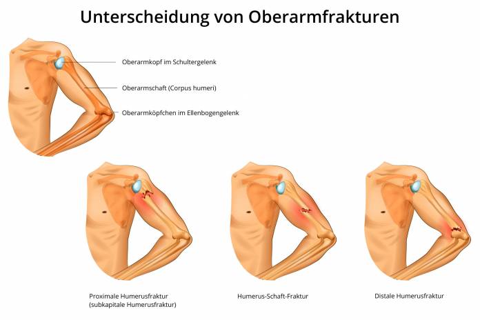 Unterscheidung von Oberarmfrakturen