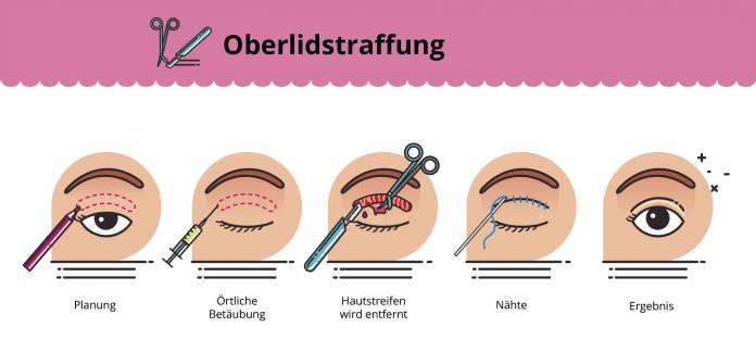 Oberlidstraffung OP-Ablauf