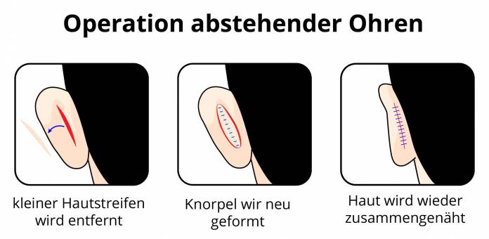 Operation von Segelohren