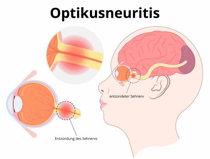 Optikusneuritis