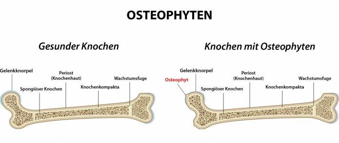 Osteophyten