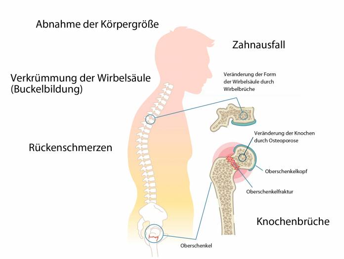 Typische Symptome einer Osteoporose