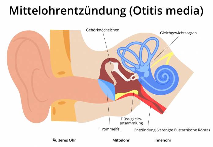 Mittelohrentzündung (Otitis media)