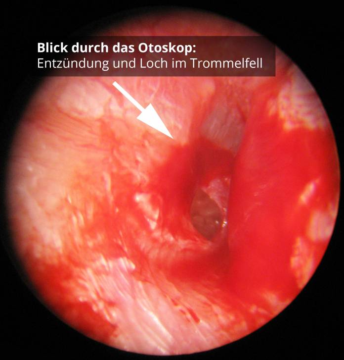 Otoskop: Loch und Entzündung des Trommelfells