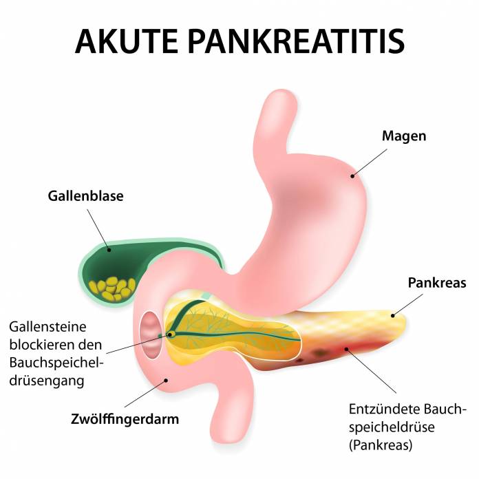 Akute Pankreatitis
