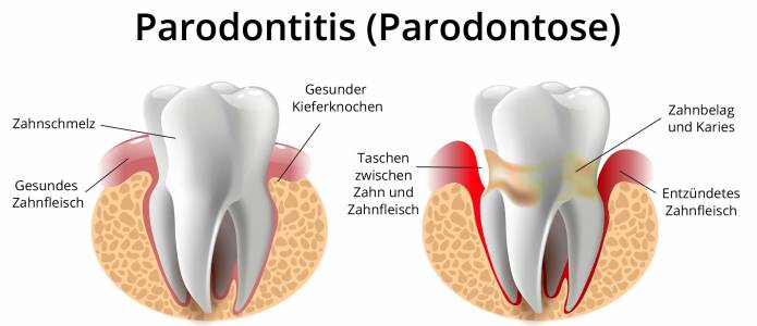 Parodontitis (Parodontose)
