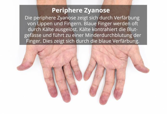Periphere Zyanose (Blaue Finger)