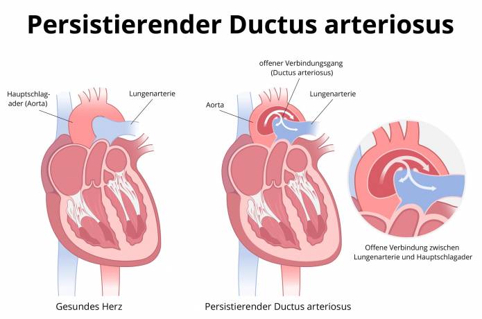 Persistierender Ductus arteriosus