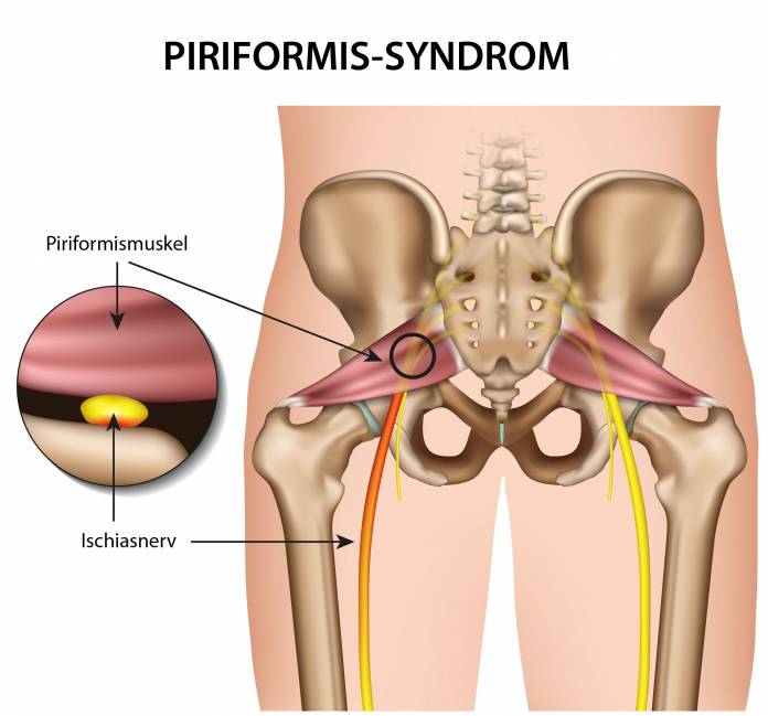 Piriformis-Syndrom