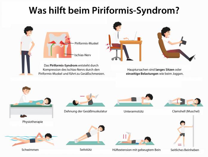 Was hilft beim Piriformis-Syndrom?
