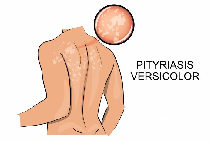 Abbildung Pityriasis versicolor