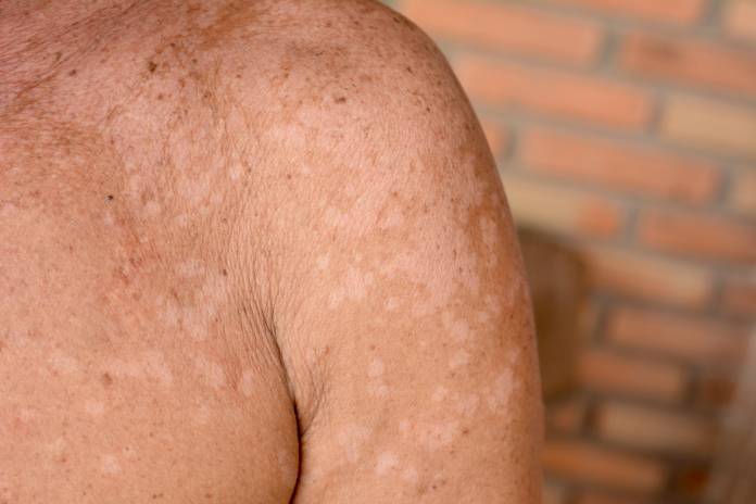 Mann mit Hautkrankheit Pityriasis versicolor