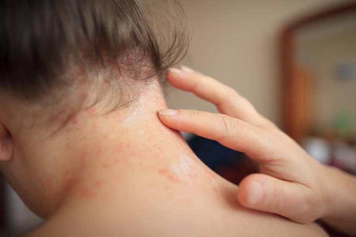 Frau mit Hauterkrankung bzw. geröteter Haut im Nacken