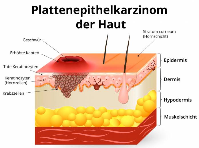 Plattenepithelkarzinom der Haut