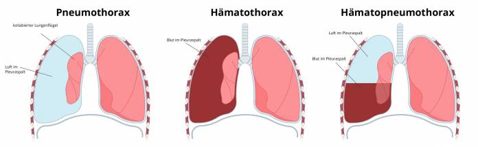 Pneumothorax Hämothorax Hämotopneumothorax Unterschied