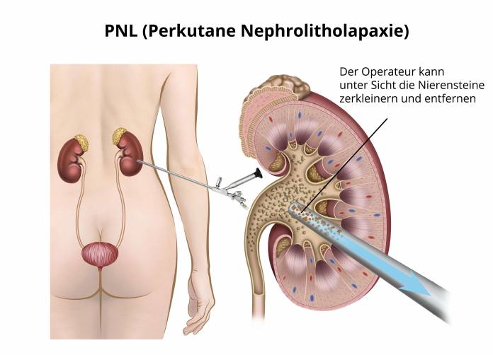 Perkutane Nephrolitholapaxie (PNL)