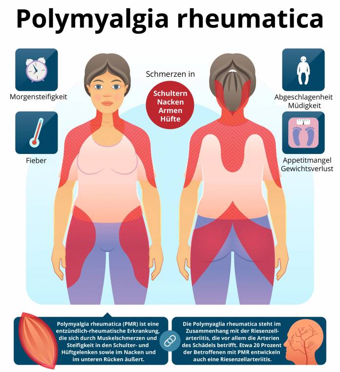 Symptome der Polymyalgia rheumatica