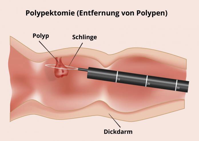 Polypektomie - Entfernung von Polypen