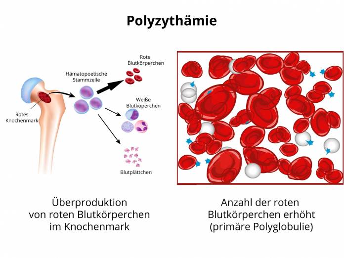 Polyzythämie - Primäre Polyglobulie