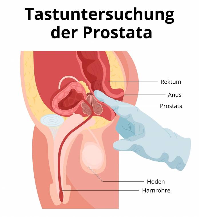 Tastuntersuchung der Prostata