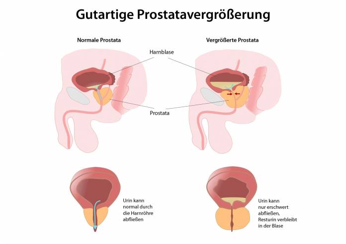 Gutartige Prostatavergrößerung