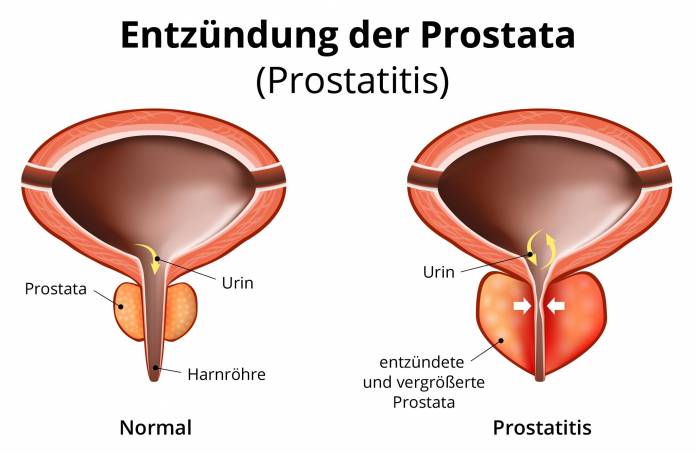 Entzündung der Prostata (Prostatitis)