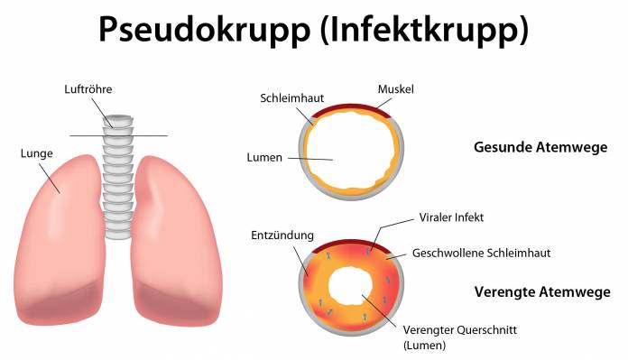 Krupp und Pseudokrupp » Ursachen, Symptome & Behandlung