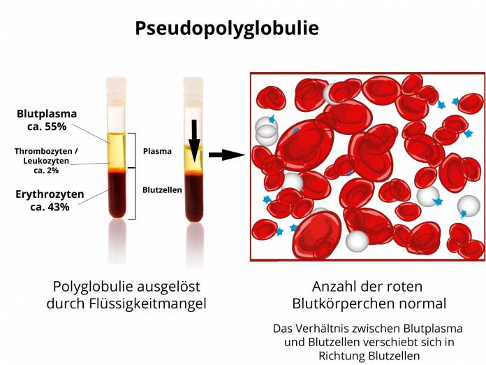 Pseudopolyglobulie