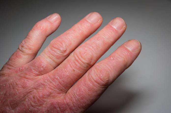 Psoriasis-Arthritis an den Fingergelenken