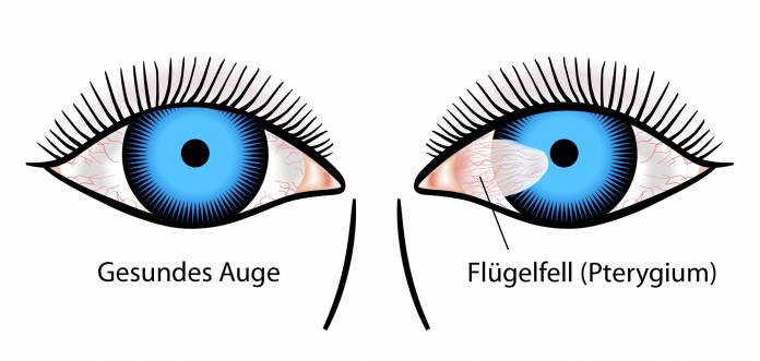 Flügelfell (Pterygium)