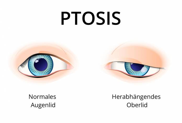 Ptosis