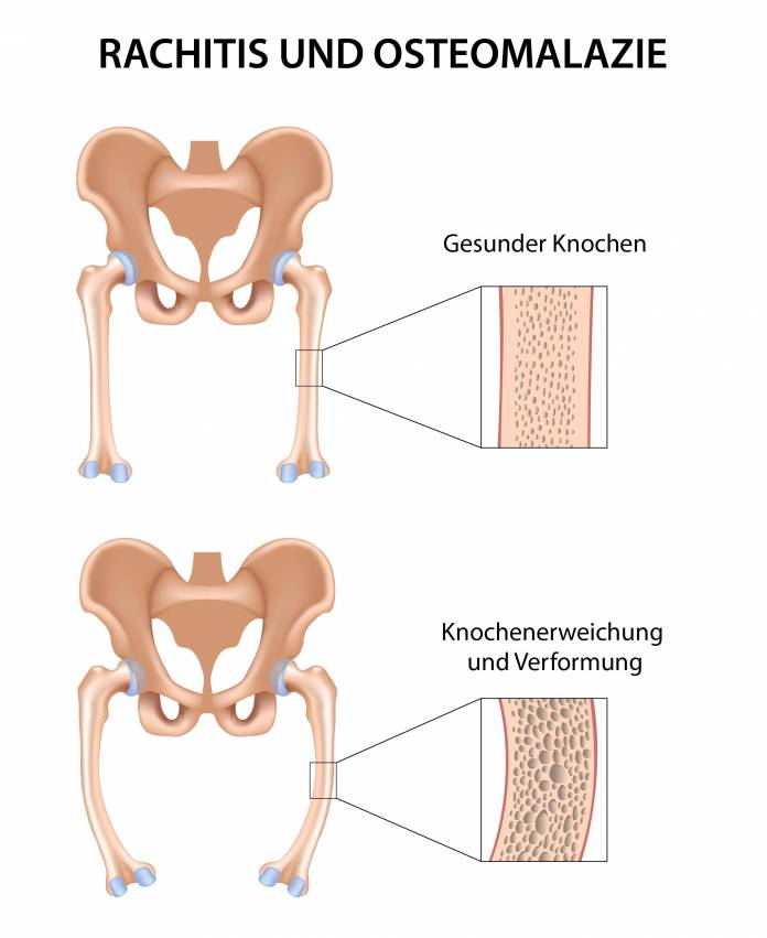 Rachitis und Osteomalazie