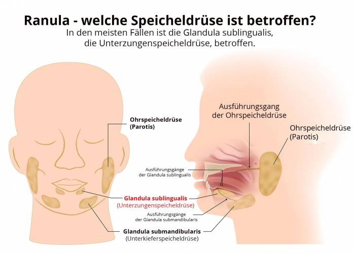 Ranula - Speicheldrüse