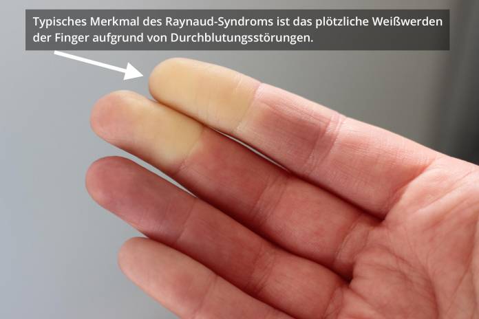 Raynaud-Syndrom an den Fingern