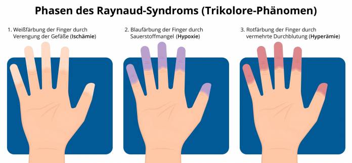 Phasen des Raynaud-Syndroms