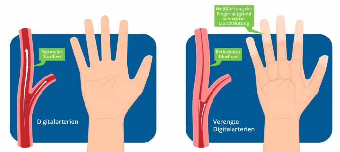 Ursachen des sekundären Raynaud-Syndroms