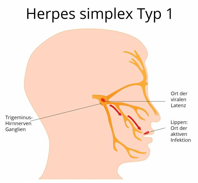 Reaktivierung der Herpes-Viren