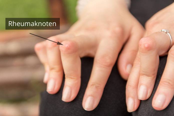 Rheumaknoten am Finger